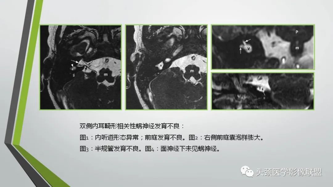 影像PPT - 【PPT】颅内神经影像解剖与病例-67