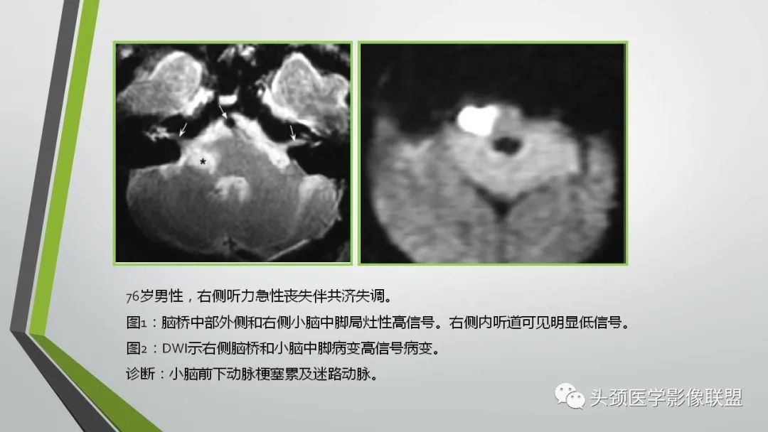 影像PPT - 【PPT】颅内神经影像解剖与病例-68
