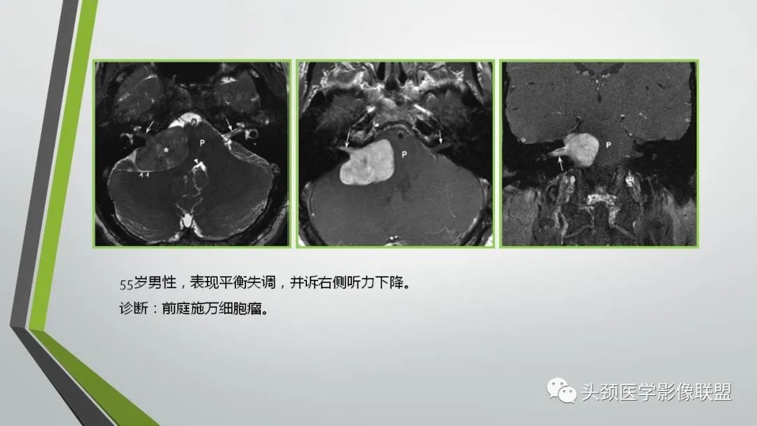 影像PPT - 【PPT】颅内神经影像解剖与病例-69