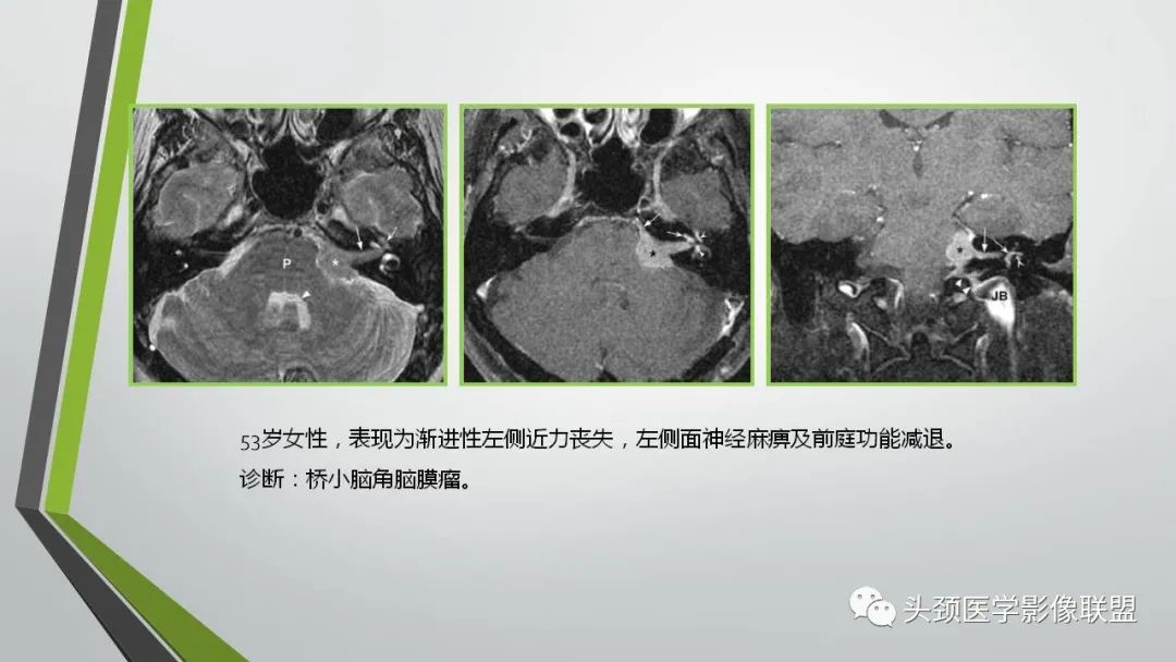 影像PPT - 【PPT】颅内神经影像解剖与病例-70