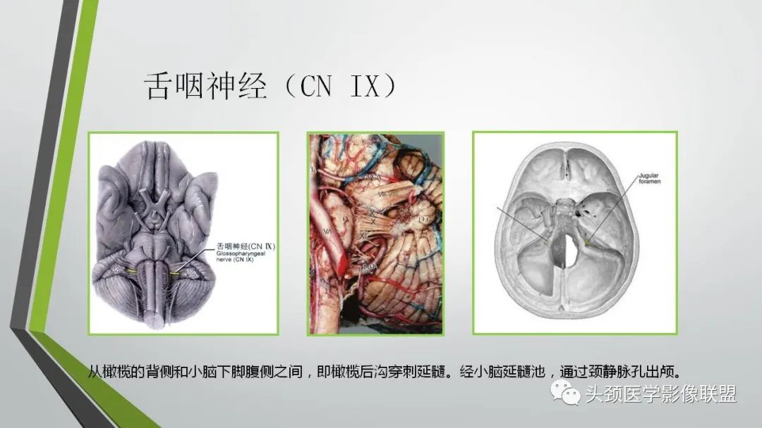 影像PPT - 【PPT】颅内神经影像解剖与病例-72