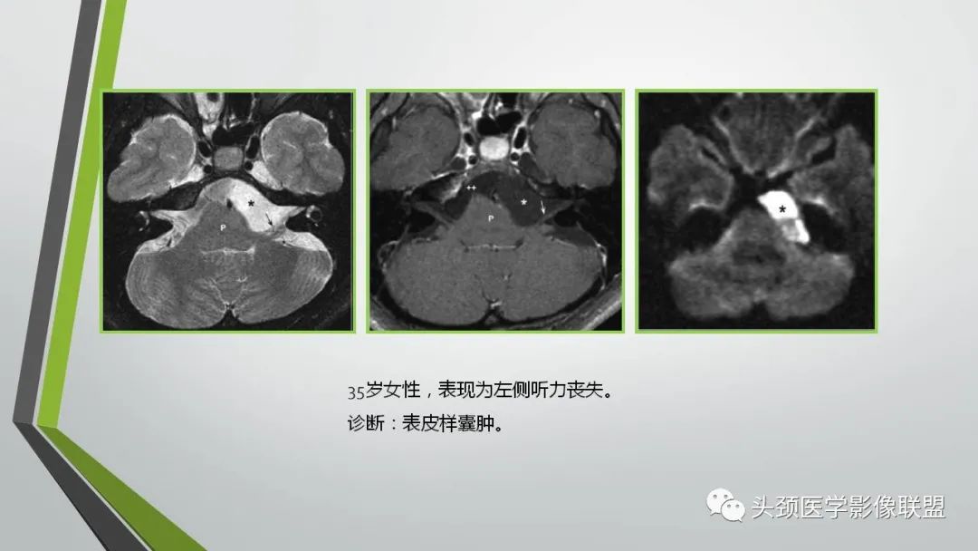 影像PPT - 【PPT】颅内神经影像解剖与病例-71