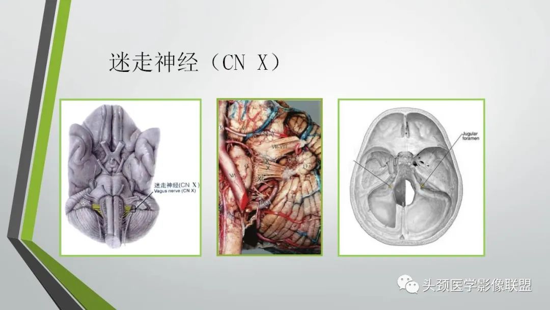 影像PPT - 【PPT】颅内神经影像解剖与病例-78