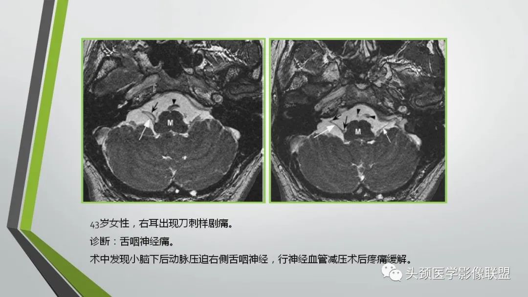 影像PPT - 【PPT】颅内神经影像解剖与病例-76