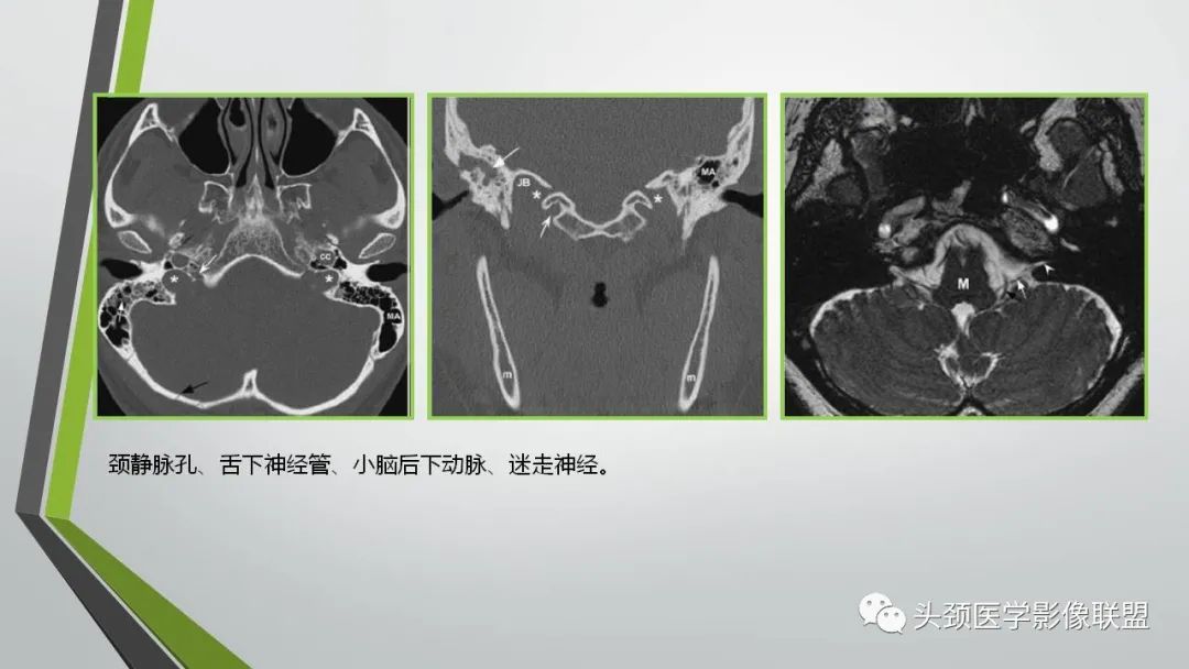 影像PPT - 【PPT】颅内神经影像解剖与病例-81