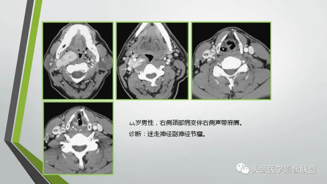 影像PPT - 【PPT】颅内神经影像解剖与病例-84