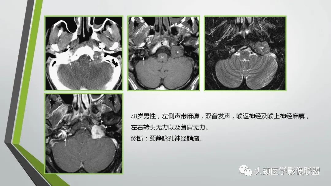 影像PPT - 【PPT】颅内神经影像解剖与病例-88