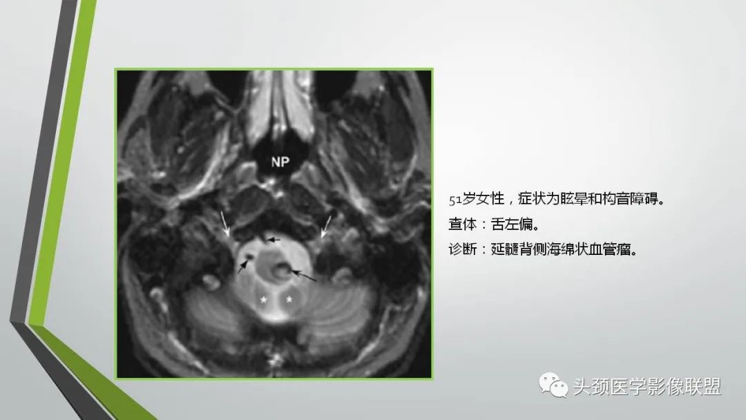 影像PPT - 【PPT】颅内神经影像解剖与病例-93