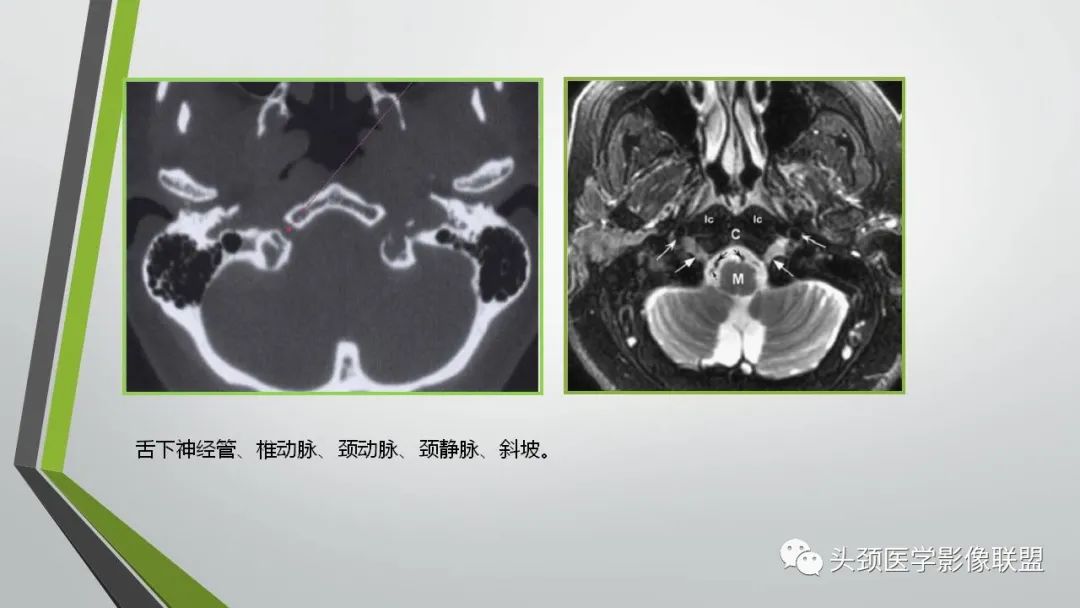 影像PPT - 【PPT】颅内神经影像解剖与病例-92