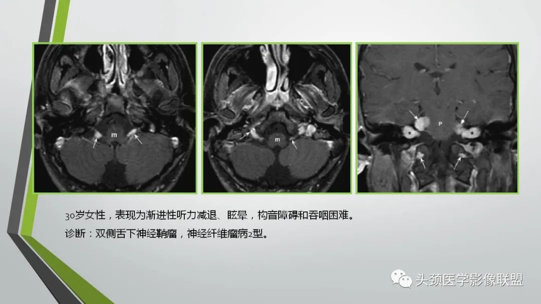影像PPT - 【PPT】颅内神经影像解剖与病例-94