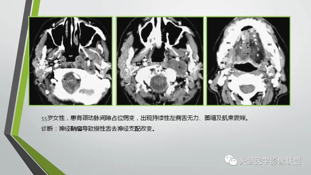 影像PPT - 【PPT】颅内神经影像解剖与病例-95