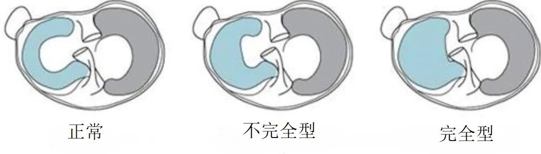 影像PPT - 盘状半月板MRI表现-2 影像PPT - 盘状半月板MRI表现-2