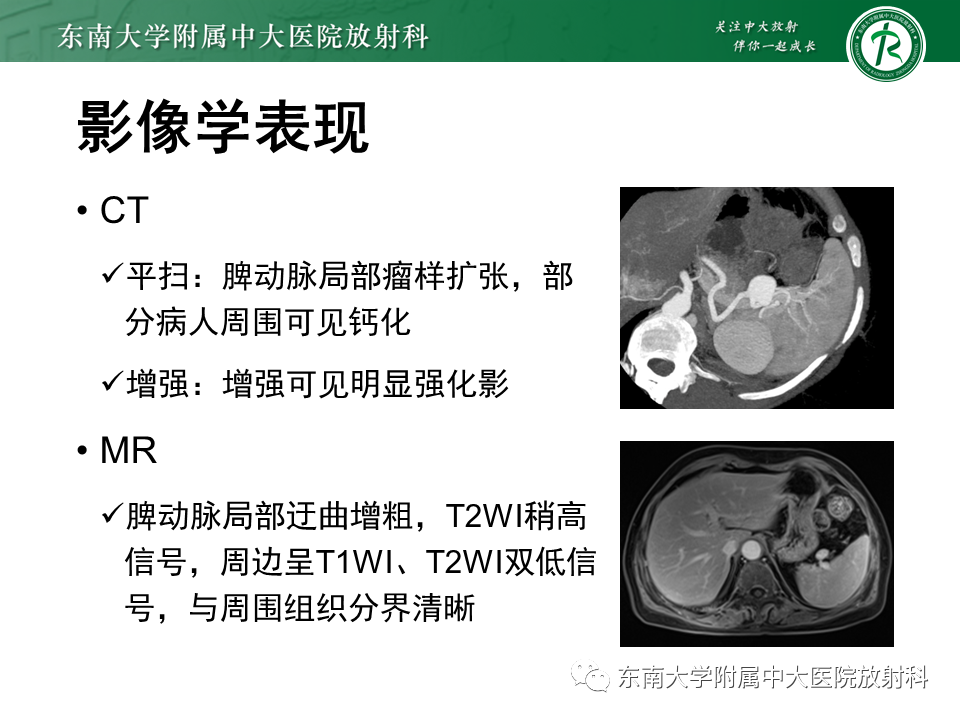 影像PPT - 【PPT】脾动脉瘤-12 影像PPT - 【PPT】脾动脉瘤-12