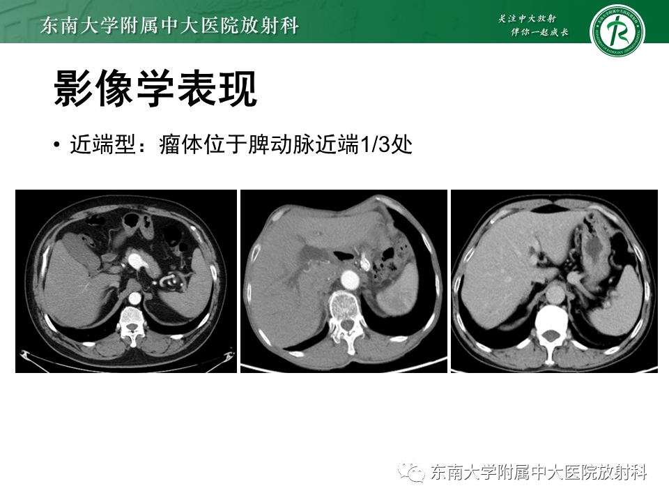 影像PPT - 【PPT】脾动脉瘤-13 影像PPT - 【PPT】脾动脉瘤-13
