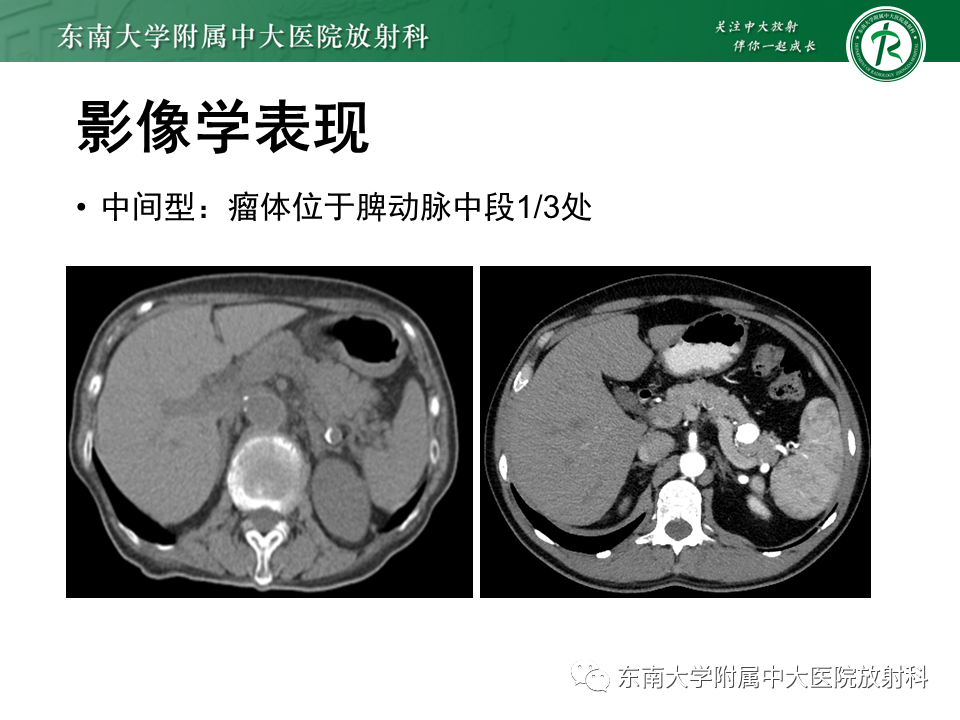 影像PPT - 【PPT】脾动脉瘤-14 影像PPT - 【PPT】脾动脉瘤-14