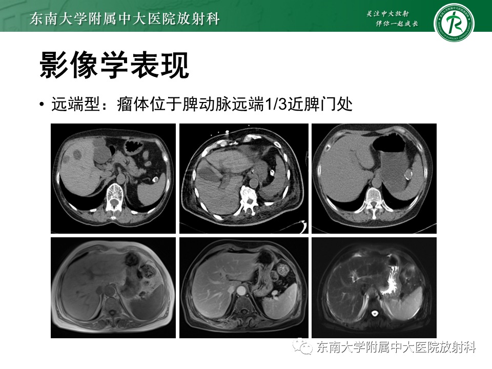 影像PPT - 【PPT】脾动脉瘤-15 影像PPT - 【PPT】脾动脉瘤-15
