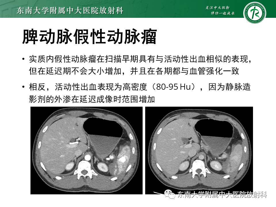影像PPT - 【PPT】脾动脉瘤-16 影像PPT - 【PPT】脾动脉瘤-16