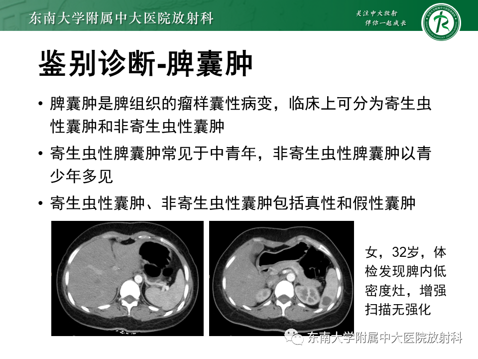 影像PPT - 【PPT】脾动脉瘤-18 影像PPT - 【PPT】脾动脉瘤-18