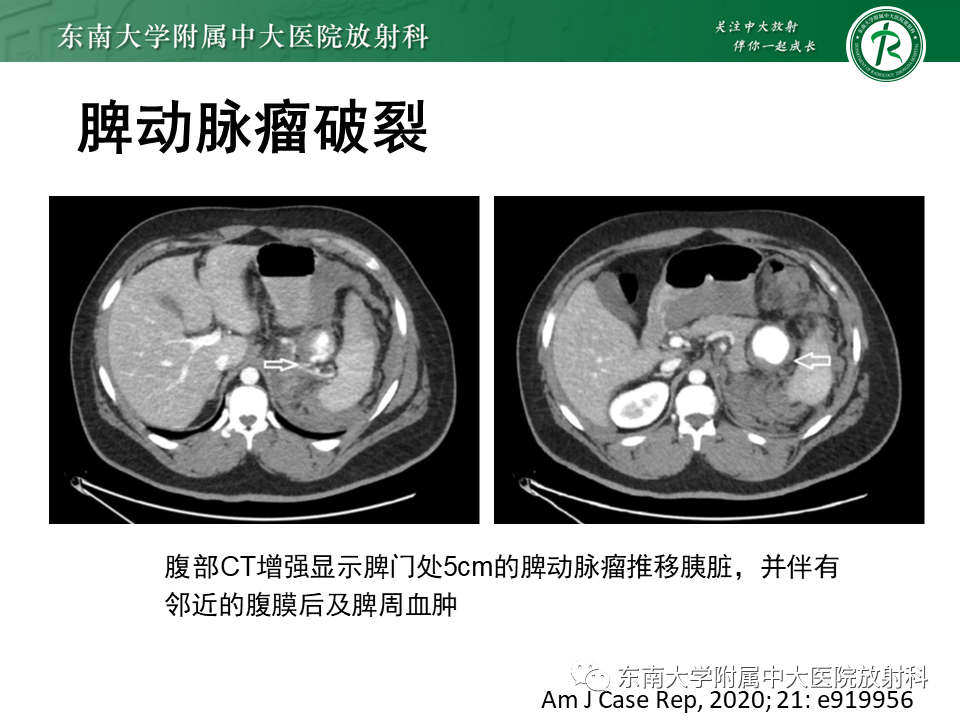 影像PPT - 【PPT】脾动脉瘤-17 影像PPT - 【PPT】脾动脉瘤-17