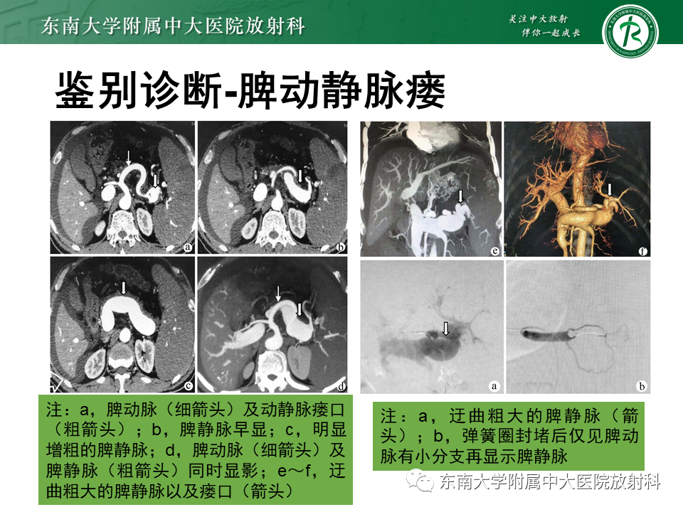 影像PPT - 【PPT】脾动脉瘤-20 影像PPT - 【PPT】脾动脉瘤-20