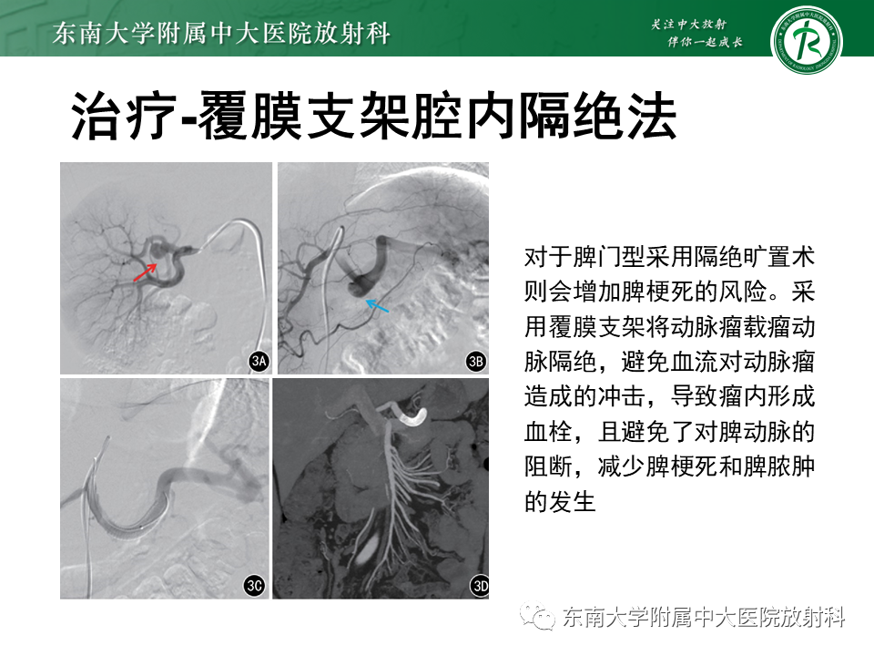 影像PPT - 【PPT】脾动脉瘤-24 影像PPT - 【PPT】脾动脉瘤-24