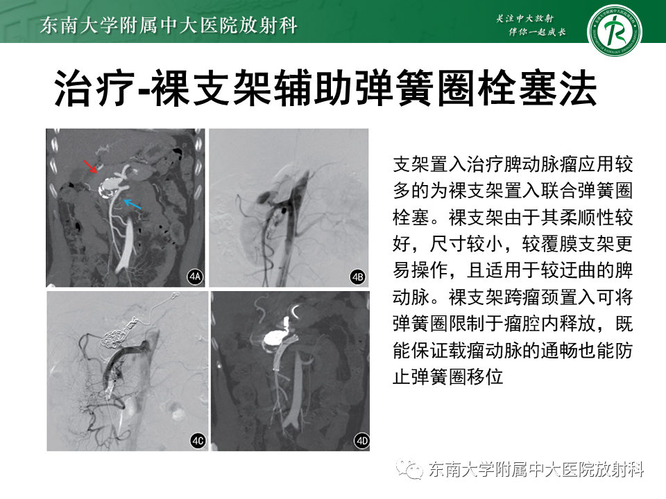 影像PPT - 【PPT】脾动脉瘤-25 影像PPT - 【PPT】脾动脉瘤-25