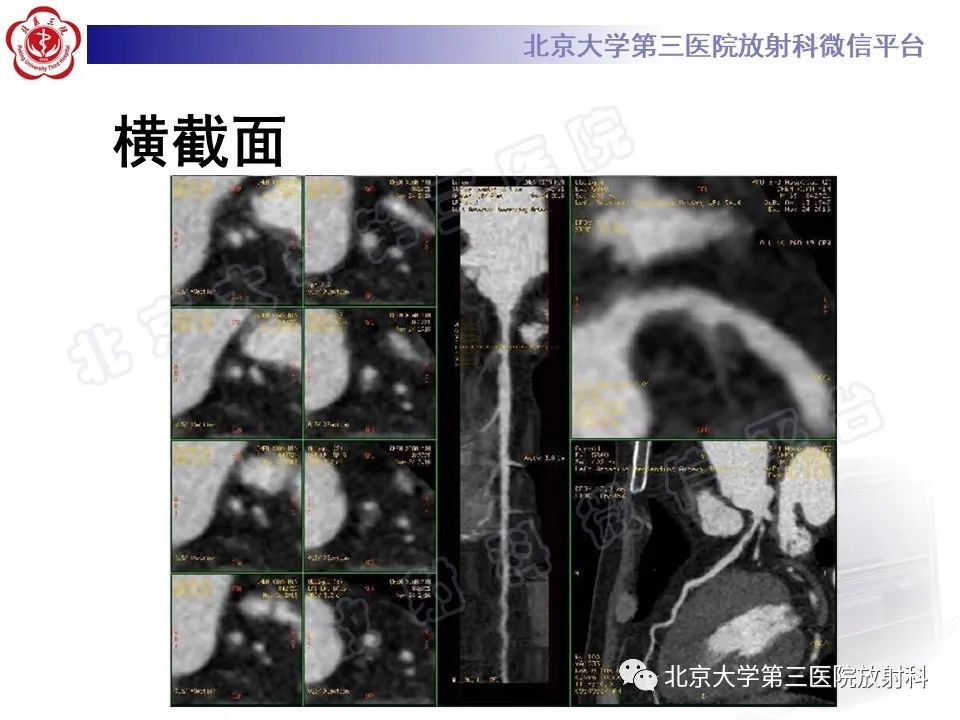 影像PPT - 【PPT】冠状动脉CT血管成像的适用标准及诊断报告书写规范-20