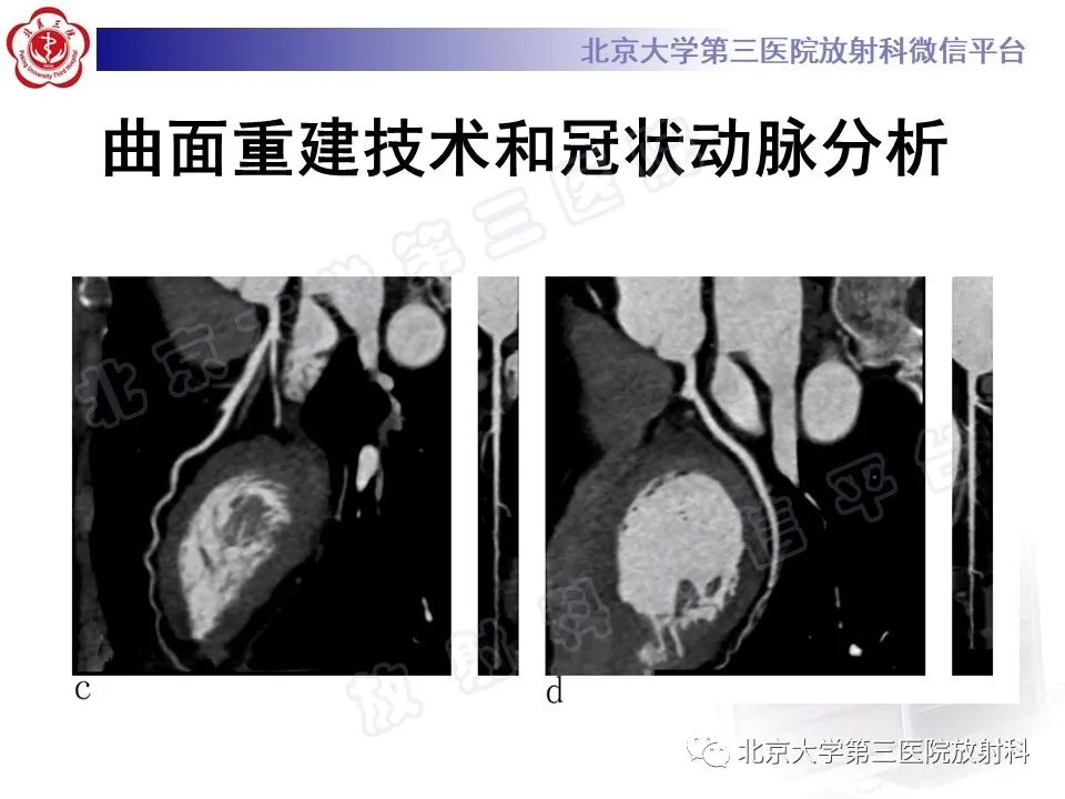 影像PPT - 【PPT】冠状动脉CT血管成像的适用标准及诊断报告书写规范-19