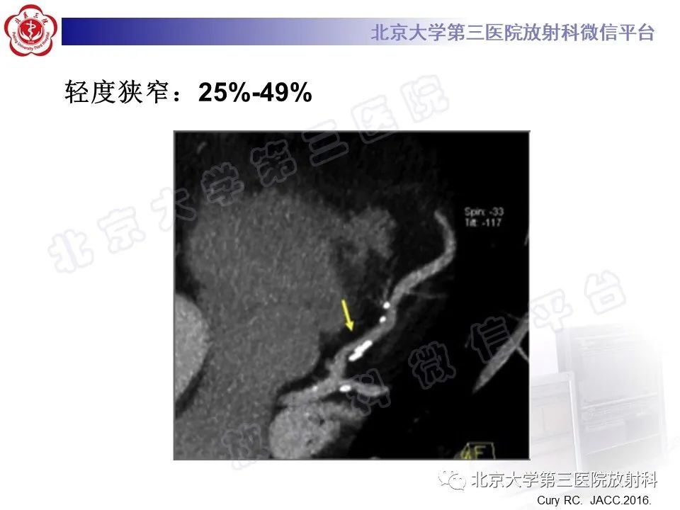 影像PPT - 【PPT】冠状动脉CT血管成像的适用标准及诊断报告书写规范-33