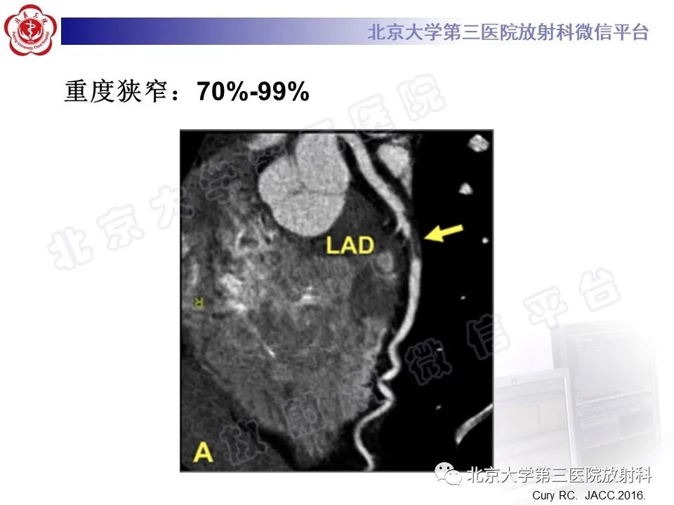 影像PPT - 【PPT】冠状动脉CT血管成像的适用标准及诊断报告书写规范-35