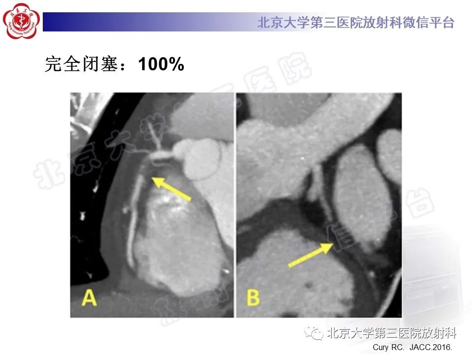 影像PPT - 【PPT】冠状动脉CT血管成像的适用标准及诊断报告书写规范-36