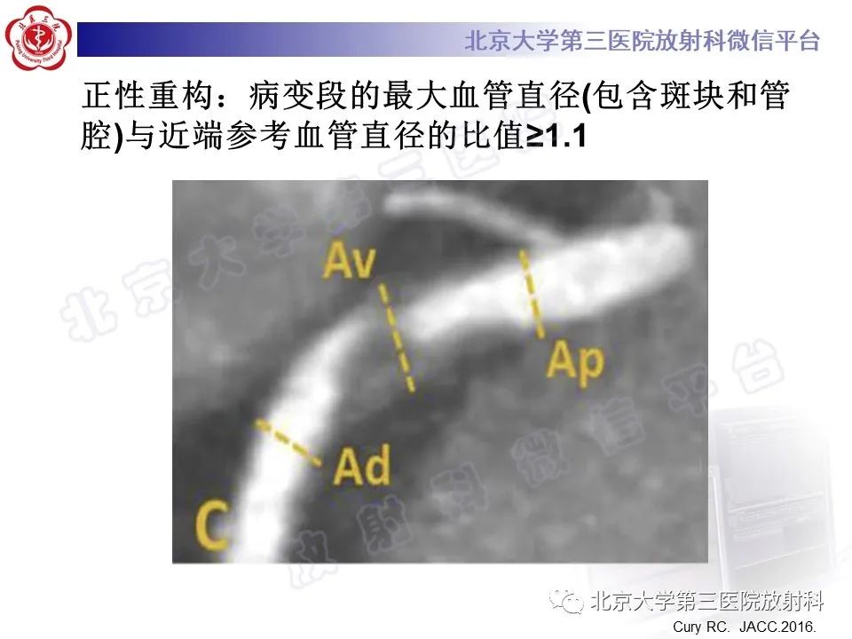影像PPT - 【PPT】冠状动脉CT血管成像的适用标准及诊断报告书写规范-39