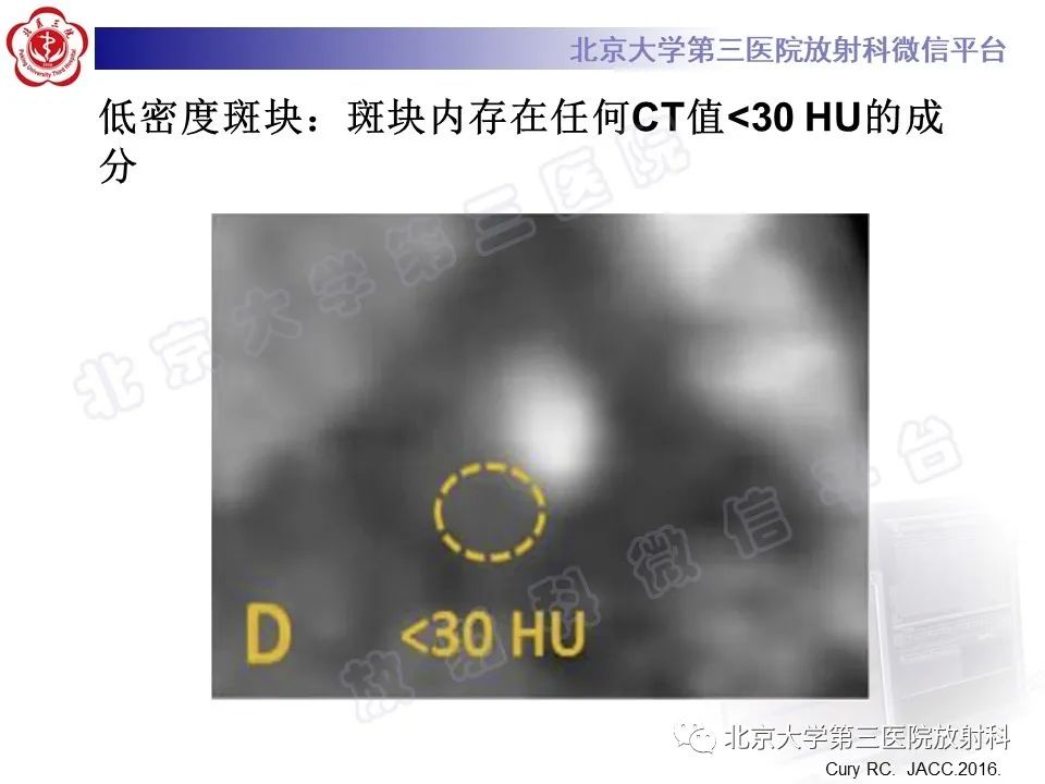 影像PPT - 【PPT】冠状动脉CT血管成像的适用标准及诊断报告书写规范-40