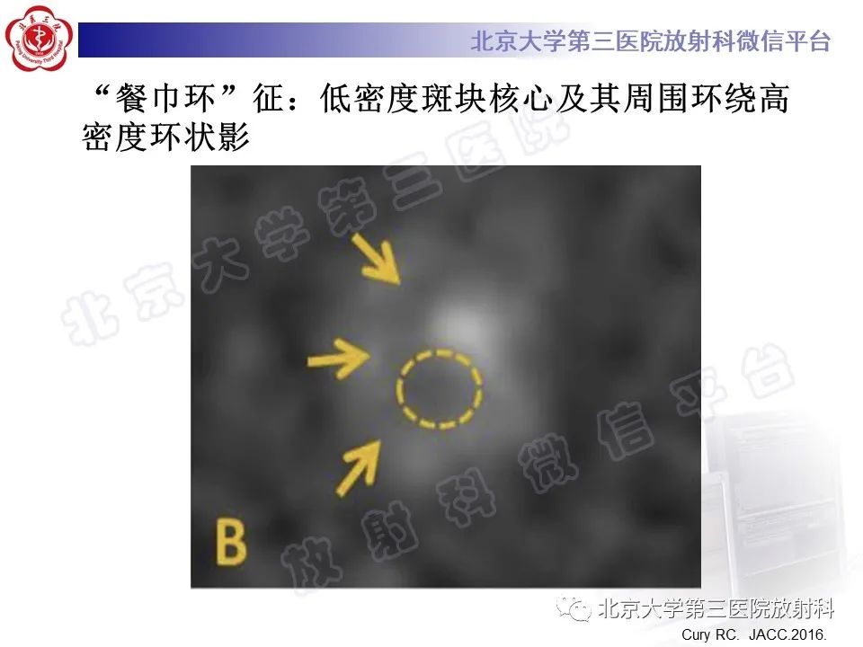 影像PPT - 【PPT】冠状动脉CT血管成像的适用标准及诊断报告书写规范-42