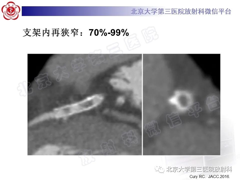 影像PPT - 【PPT】冠状动脉CT血管成像的适用标准及诊断报告书写规范-48