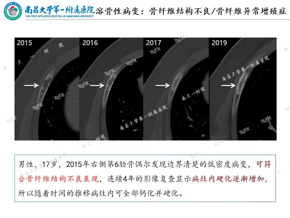 影像PPT - 【PPT】非创伤性肋骨病变及影像诊断思路-7