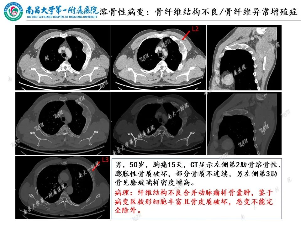 影像PPT - 【PPT】非创伤性肋骨病变及影像诊断思路-8