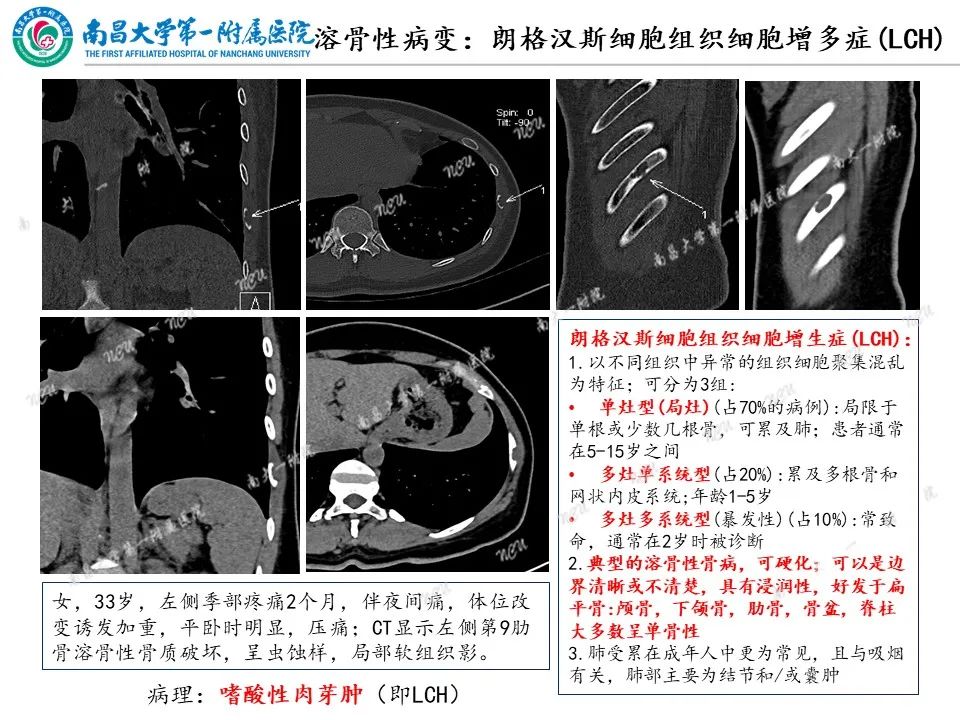 影像PPT - 【PPT】非创伤性肋骨病变及影像诊断思路-9