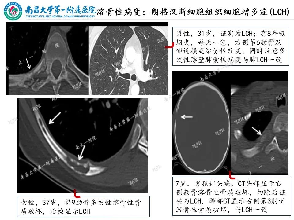影像PPT - 【PPT】非创伤性肋骨病变及影像诊断思路-10