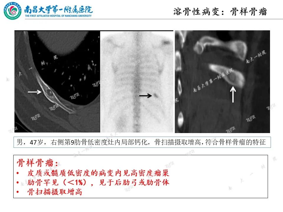 影像PPT - 【PPT】非创伤性肋骨病变及影像诊断思路-11
