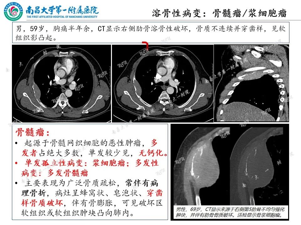 影像PPT - 【PPT】非创伤性肋骨病变及影像诊断思路-14