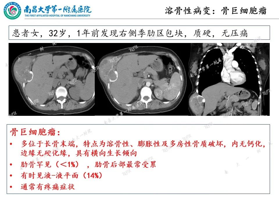 影像PPT - 【PPT】非创伤性肋骨病变及影像诊断思路-12