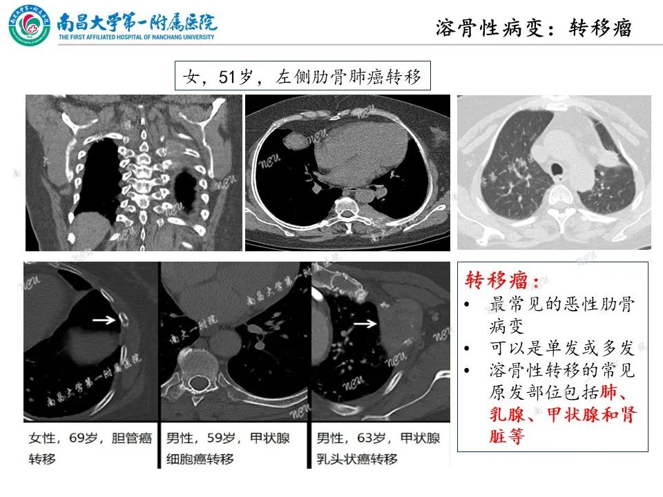 影像PPT - 【PPT】非创伤性肋骨病变及影像诊断思路-15