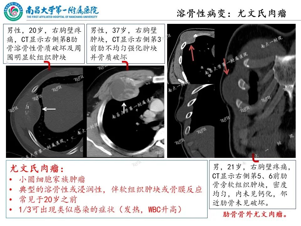 影像PPT - 【PPT】非创伤性肋骨病变及影像诊断思路-16