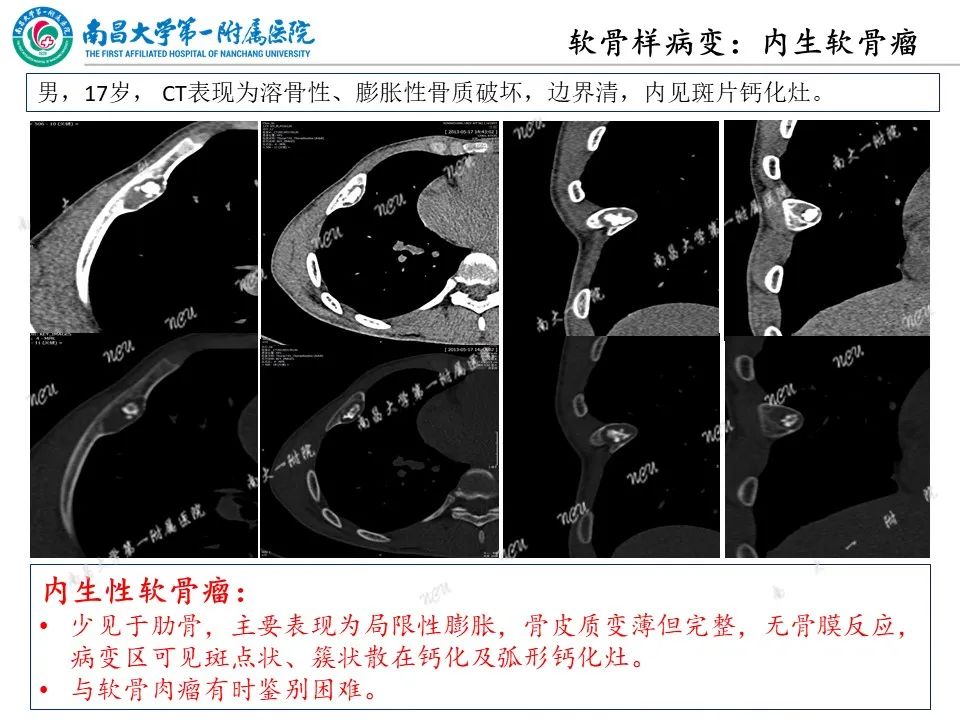 影像PPT - 【PPT】非创伤性肋骨病变及影像诊断思路-17