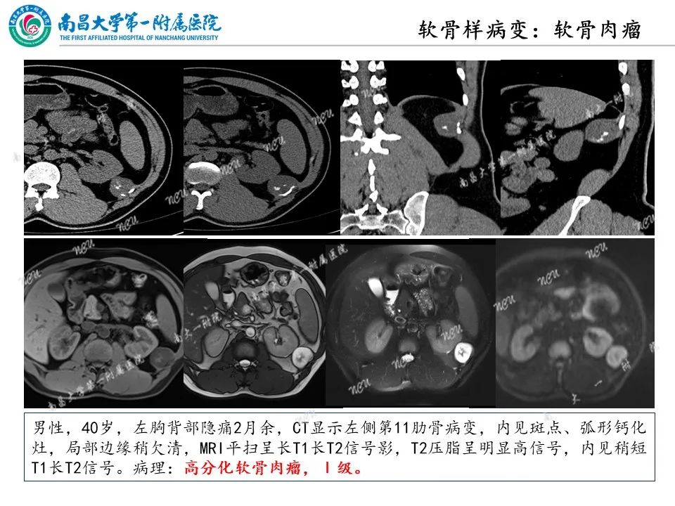 影像PPT - 【PPT】非创伤性肋骨病变及影像诊断思路-22