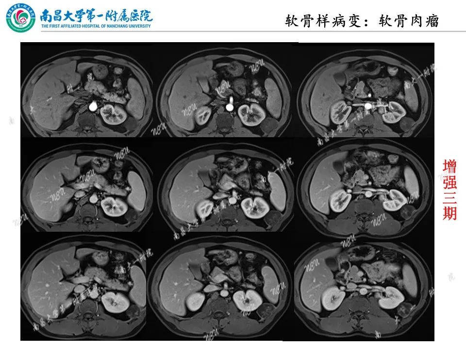 影像PPT - 【PPT】非创伤性肋骨病变及影像诊断思路-23