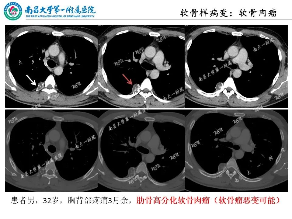影像PPT - 【PPT】非创伤性肋骨病变及影像诊断思路-25