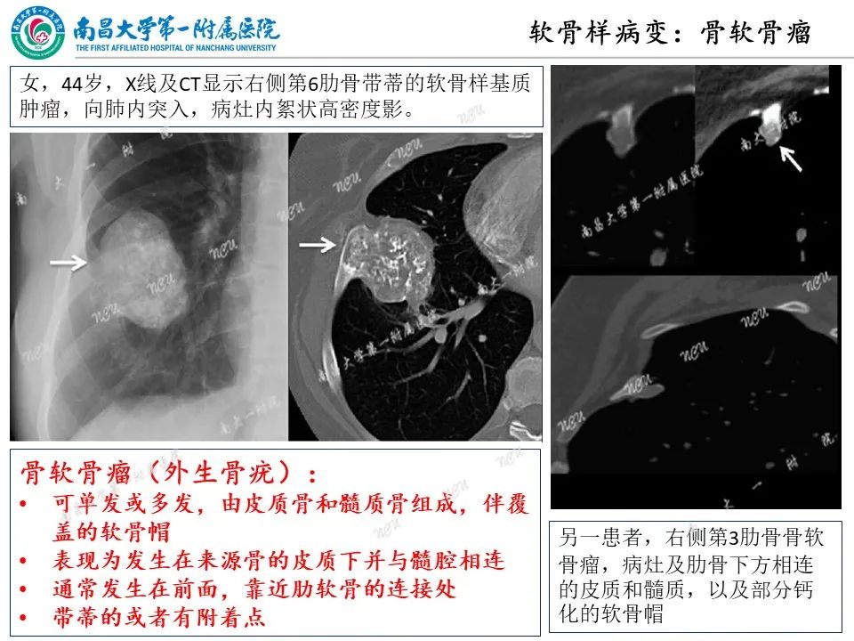 影像PPT - 【PPT】非创伤性肋骨病变及影像诊断思路-26