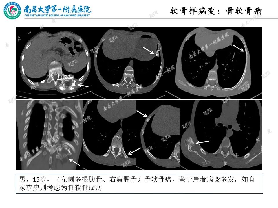影像PPT - 【PPT】非创伤性肋骨病变及影像诊断思路-27